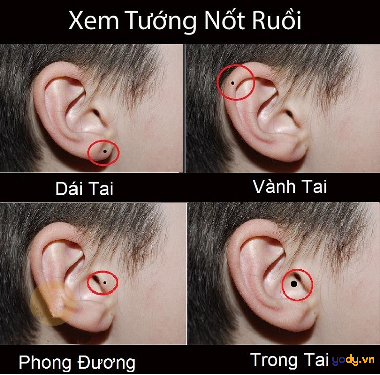 nốt ruồi sau tai